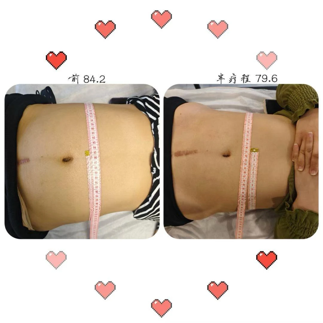 Abdominal care: original treatment comparison, with its original labels