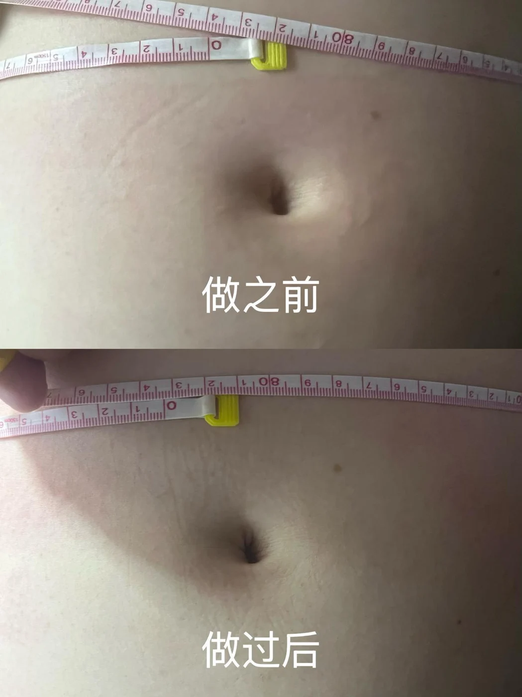 Abdominal care: original treatment comparison, with its original labels